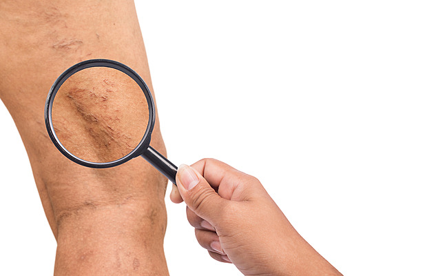 Křečové žíly: dědičné riziko, které vás může zaskočit. Poznejte příznaky včas