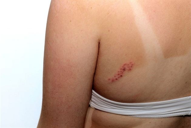 Mýty o pásovém oparu. Pravda, kterou by měl znát každý